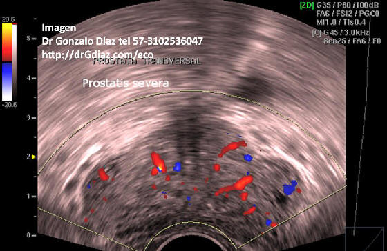 prostatitis